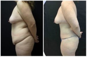 18605d556cd2d586e56-tummy-tuck-abdominoplasty - Tummy Tuck - Before And After - Abdominoplasty - Fairfax and Manassas VA