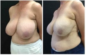 Breast Reduction Liposuction - Before And After - Fairfax and Manassas VA