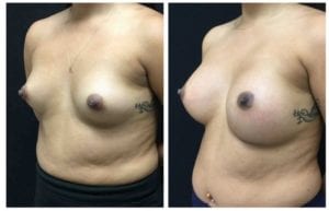 18686b-breast-augmentation - Breast Augmentation Before And After - Fairfax and Manassas VA