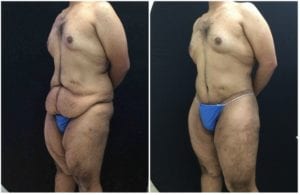 18831b-lower-body-lift - Lower Body Lift - Before And After - Fairfax and Manassas VA