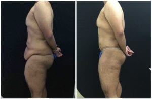 18831c-lower-body-lift - Lower Body Lift - Before And After - Fairfax and Manassas VA