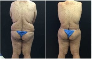18831d-lower-body-lift - Lower Body Lift - Before And After - Fairfax and Manassas VA