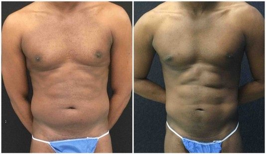 18859a56b3c89a213c5-liposuction - Liposuction - Before And After - Fairfax and Manassas VA