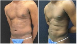 Abdominal Etching - Before And After - Fairfax and Manassas VA