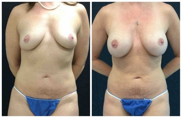 18910a-breast-augmentation - Breast Augmentation Before And After - Fairfax and Manassas VA