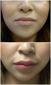 Juvederm - Before And After | Fairfax and Manassas VA
