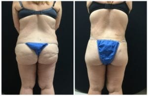 18995c-lower-body-lift - Lower Body Lift - Before And After - Fairfax and Manassas VA