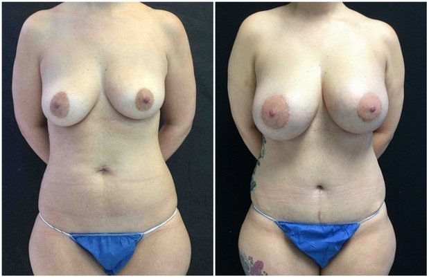 19182a-breast-augmentation - Breast Augmentation Before And After - Fairfax and Manassas VA