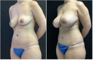19182b-breast-augmentation - Breast Augmentation Before And After - Fairfax and Manassas VA