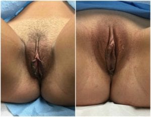 Labiaplasty - Before And After - Fairfax and Manassas VA