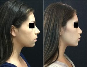 19335-20170331_Draw158dead79111e6-non-surgical-chin-augmentation - Non-Surgical Chin Augmentation - Before And After | Fairfax and Manassas VA