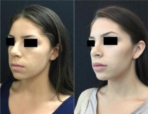 Non-Surgical Chin Augmentation - Before And After | Fairfax and Manassas VA