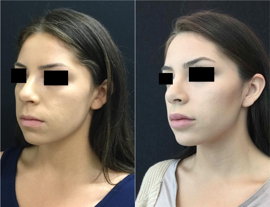 19335-20170331_Draw58dead794fd28-non-surgical-chin-augmentation - Non-Surgical Chin Augmentation - Before And After | Fairfax and Manassas VA