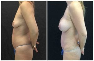 19389c-tummy-tuck-abdominoplasty - Tummy Tuck & Abdominoplasty - Before And After - Fairfax and Manassas VA
