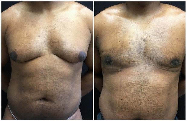 19451a-male-breast-reduction - Male Breast Reduction - Before And After - Gynecomastia - Fairfax and Manassas VA