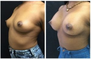 19456b-breast-augmentation - Breast Augmentation Before And After - Fairfax and Manassas VA