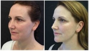Ultherapy Lift - Before And After | Fairfax and Manassas VA
