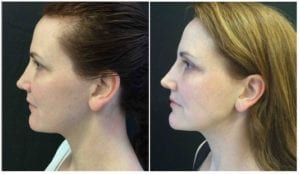19458c-ultherapy-lift - Ultherapy Lift - Before And After | Fairfax and Manassas VA