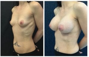 19482b-breast-augmentation - Breast Augmentation Before And After - Fairfax and Manassas VA