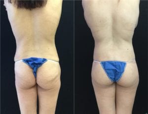 19513-20170515_Butt-Lift-Canvas-lower-body-lift - Lower Body Lift - Before And After - Fairfax and Manassas VA