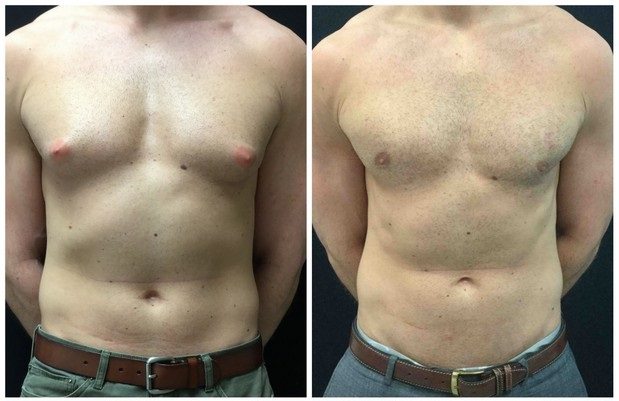 19536a563bf8b0e61b9-male-breast-reduction - Male Breast Reduction - Before And After - Gynecomastia - Fairfax and Manassas VA