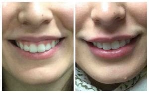 Gummy Smile Reduction - Before And After | Fairfax and Manassas VA