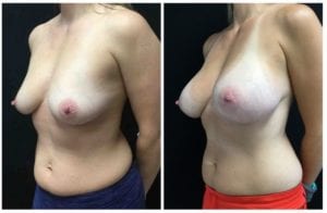 19632b57a3a2f19249f-breast-augmentation - Breast Augmentation Before And After - Fairfax and Manassas VA