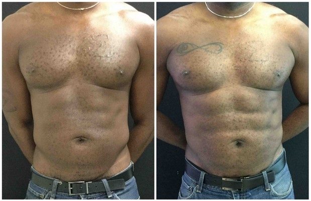 19740aa-abdominal-etching - Abdominal Etching - Before And After - Fairfax and Manassas VA