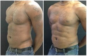 19740bb-abdominal-etching - Abdominal Etching - Before And After - Fairfax and Manassas VA