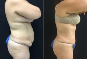 19770-side-tummy-tuck-abdominoplasty - Tummy Tuck & Abdominoplasty - Before And After - Fairfax and Manassas VA