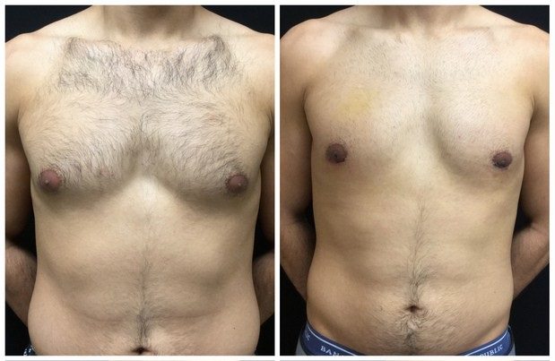 19935a-male-breast-reduction - Male Breast Reduction - Before And After - Gynecomastia - Fairfax and Manassas VA
