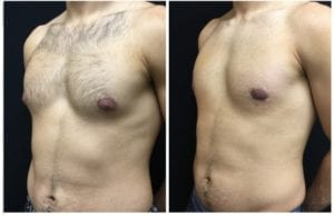 19935b-male-breast-reduction - Male Breast Reduction - Before And After - Gynecomastia - Fairfax and Manassas VA
