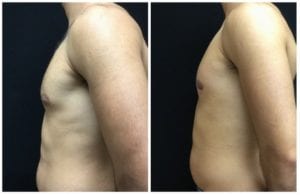 19935c-male-breast-reduction - Male Breast Reduction - Before And After - Gynecomastia - Fairfax and Manassas VA