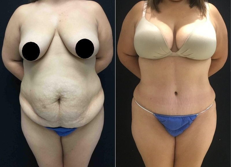 19970-front-tummy-tuck-abdominoplasty - Tummy Tuck & Abdominoplasty - Before And After - Fairfax and Manassas VA