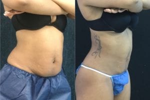 19996-20170420_Crop-coolsculpting - Non-Surgical Tummy Tuck - Before And After - Fairfax and Manassas VA