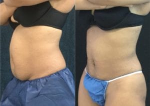 Non-Surgical Tummy Tuck - Before And After - Fairfax and Manassas VA