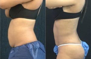 Non-Surgical Tummy Tuck - Before And After - Fairfax and Manassas VA