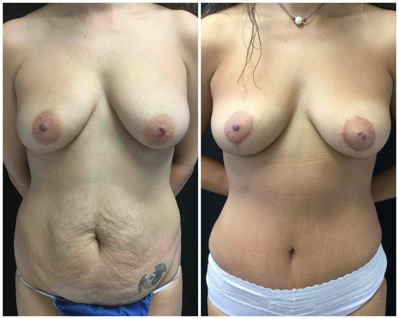 2016-11-14-breast-lift - Breast Lift - Mastopexy Before And After - Fairfax and Manassas VA