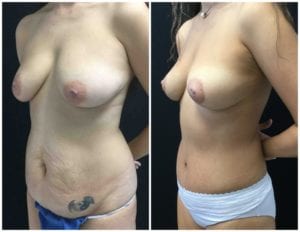 Breast Lift - Mastopexy Before And After - Fairfax and Manassas VA