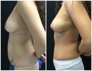 Breast Lift - Mastopexy Before And After - Fairfax and Manassas VA