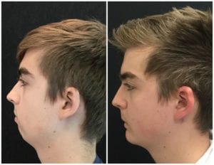 2016-11-153-chin-implant - Chin Implant Before And After - Fairfax and Manassas VA