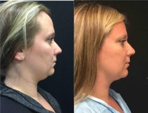 Neck Liposuction - Before And After | Fairfax and Manassas VA