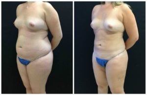 20305b-liposuction - Liposuction - Before And After - Fairfax and Manassas VA