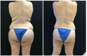 20305c-liposuction - Liposuction - Before And After - Fairfax and Manassas VA