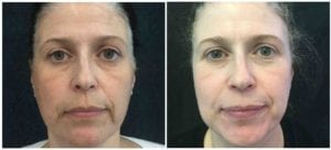 Melanage Peel - Before And After | Fairfax and Manassas VA