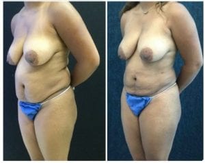 20383b-liposuction - Liposuction - Before And After - Fairfax and Manassas VA