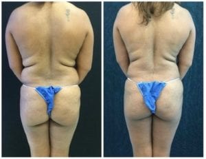 20383c-liposuction - Liposuction - Before And After - Fairfax and Manassas VA