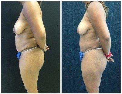 20383d-liposuction - Liposuction - Before And After - Fairfax and Manassas VA