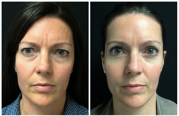 20391a-eyelid-lift-upper-and-lower - Upper and Lower Eyelid Lift - Before And After - Fairfax and Manassas VA