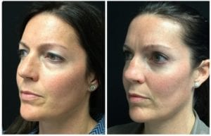 20391b-eyelid-lift-upper-and-lower - Upper and Lower Eyelid Lift - Before And After - Fairfax and Manassas VA